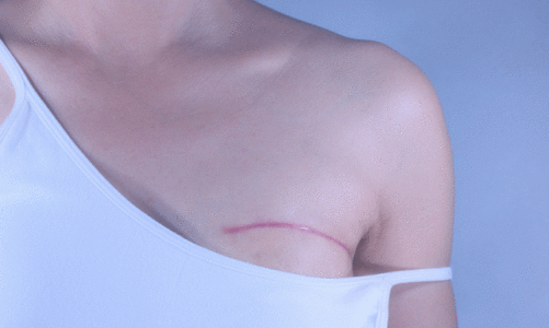 8 síntomas poco conocidos del cáncer de mama